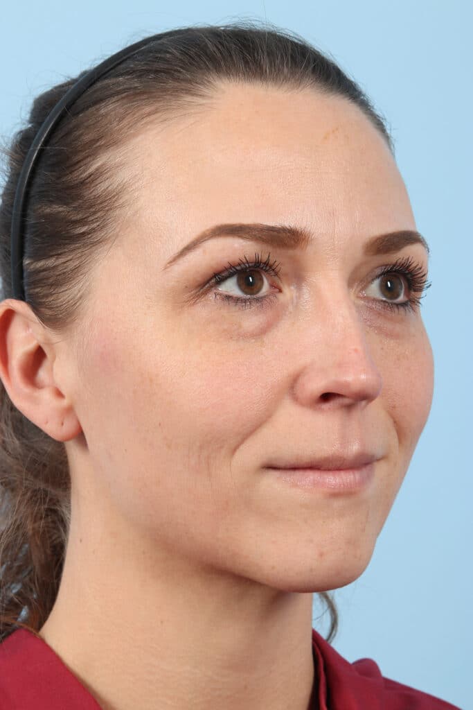 Before Image: Eyelift - right-front-oblique