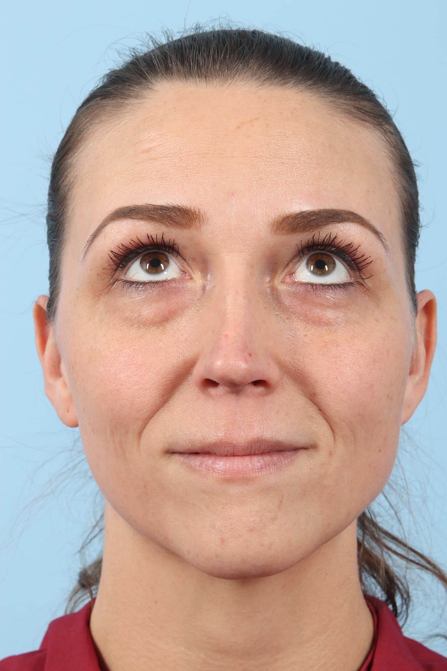 Before Image: Eyelift - front