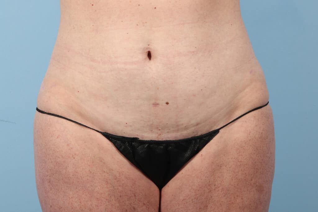 After Image: Tummy Tuck - front