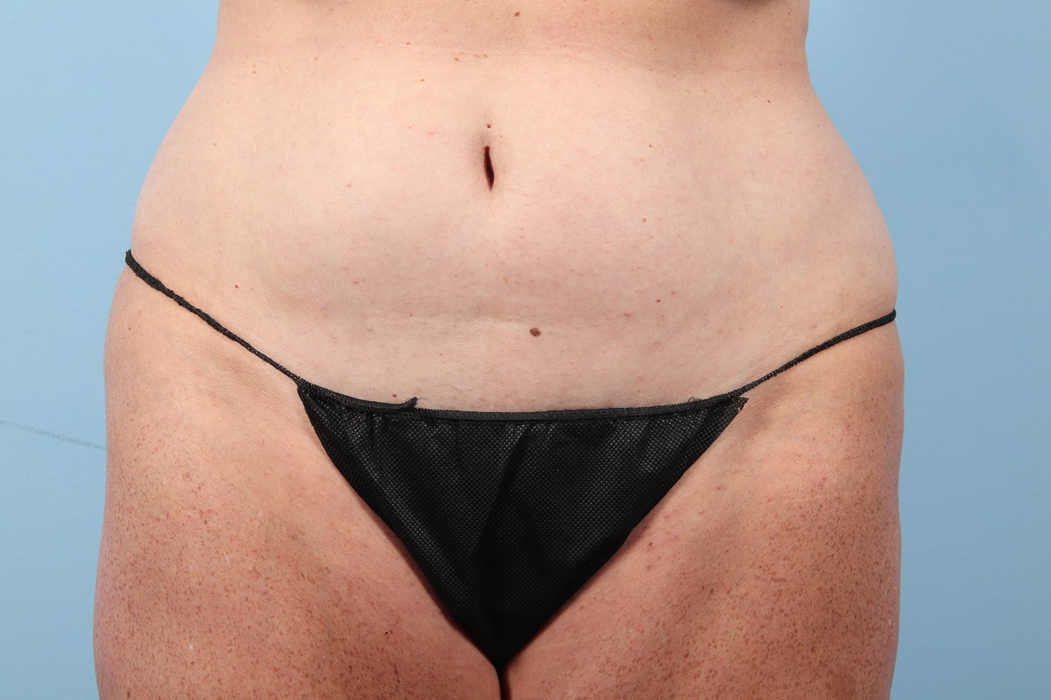 Before Image: Tummy Tuck - front