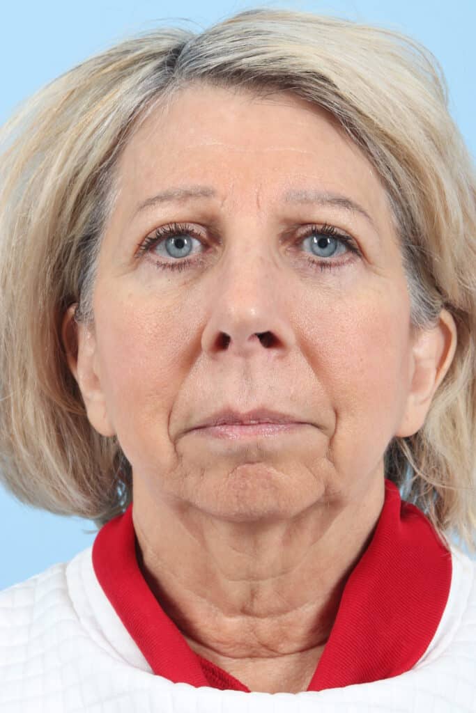 After Image: Brow, Eyes, Forehead - front