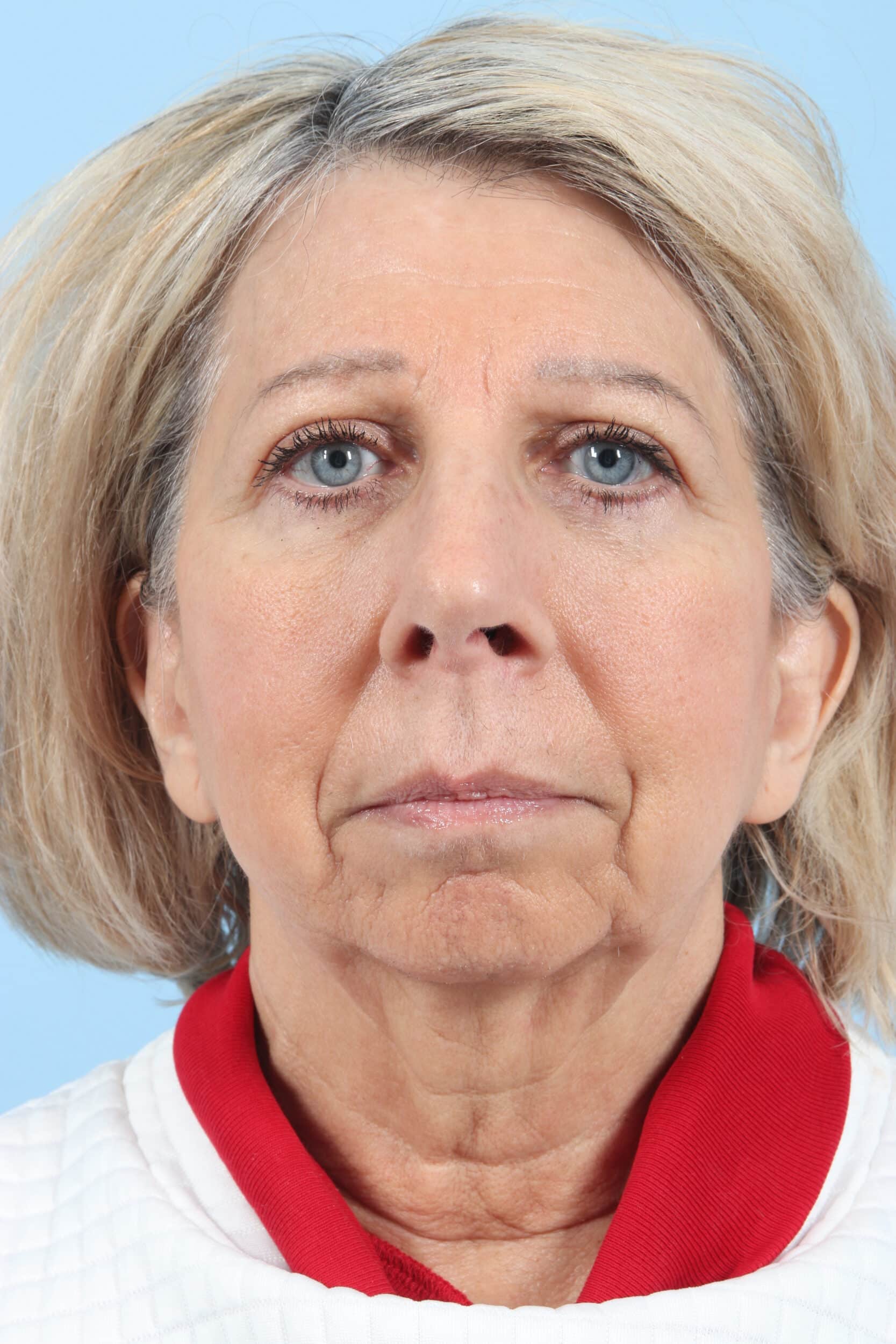 After Image: Brow, Eyes, Forehead - front