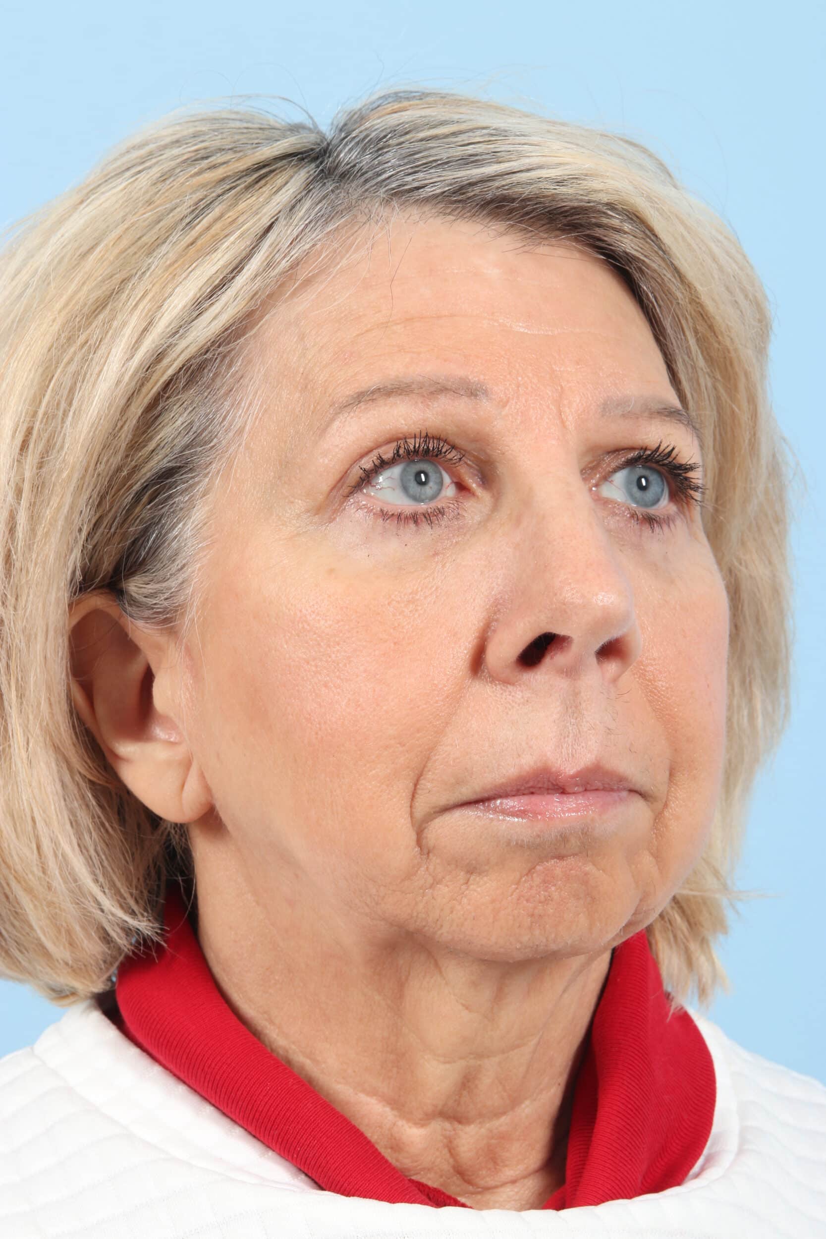 After Image: Brow, Eyes, Forehead - right-front-oblique