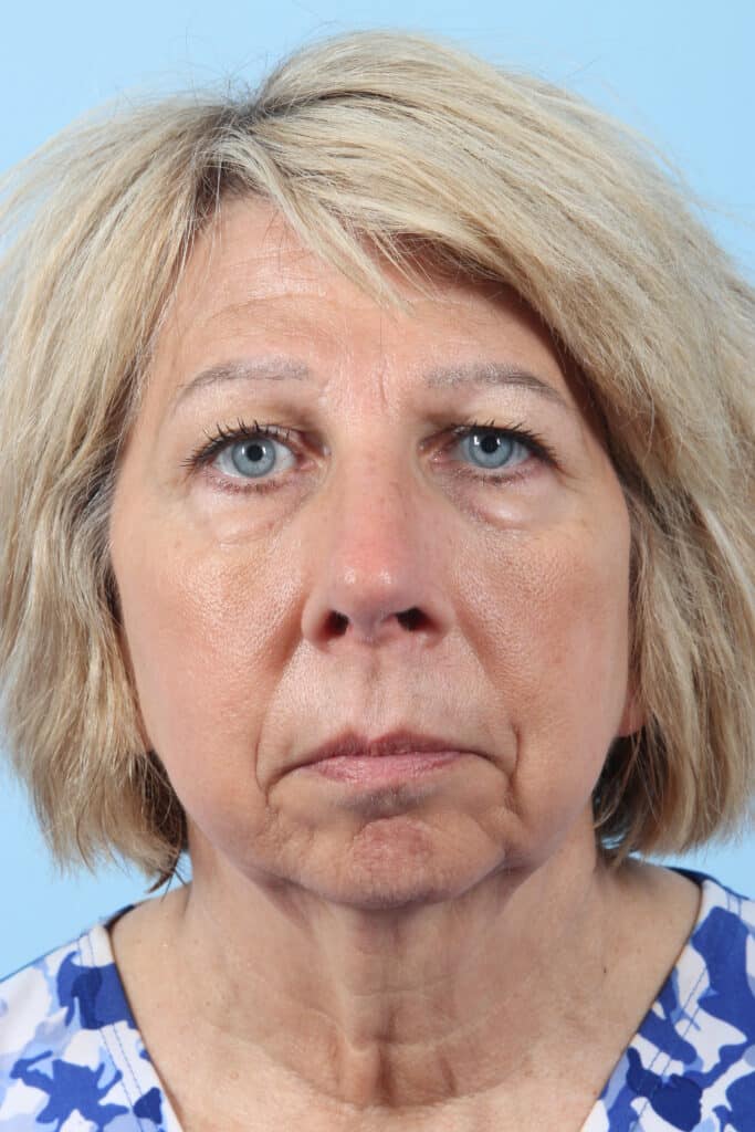 Before Image: Brow, Eyes, Forehead - front