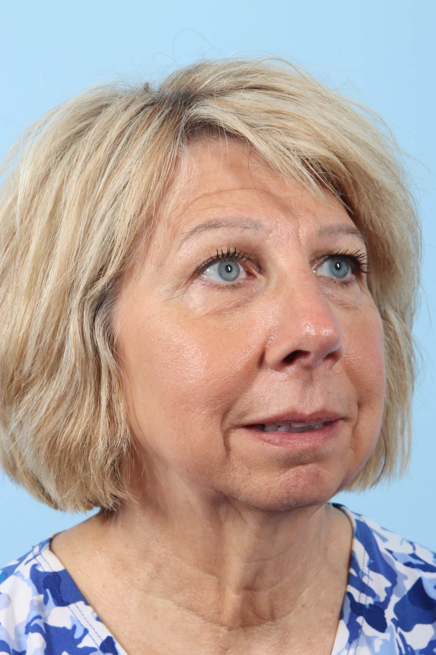 Before Image: Brow, Eyes, Forehead - right-front-oblique