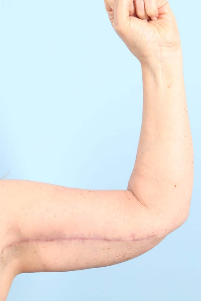 After Image: Arm Kift - front