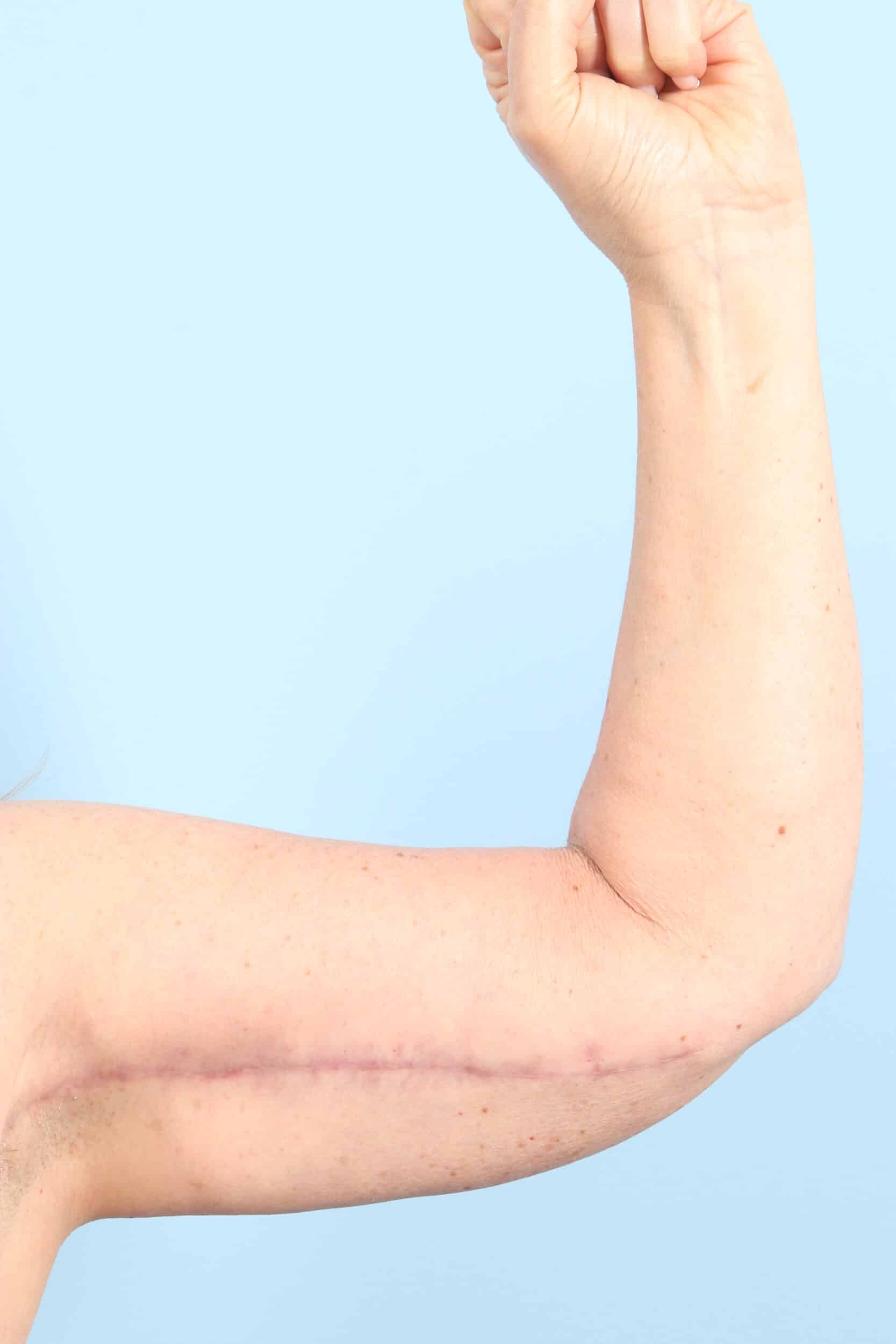 After Image: Arm Kift - front