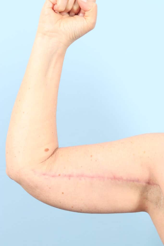 After Image: Arm Kift - front