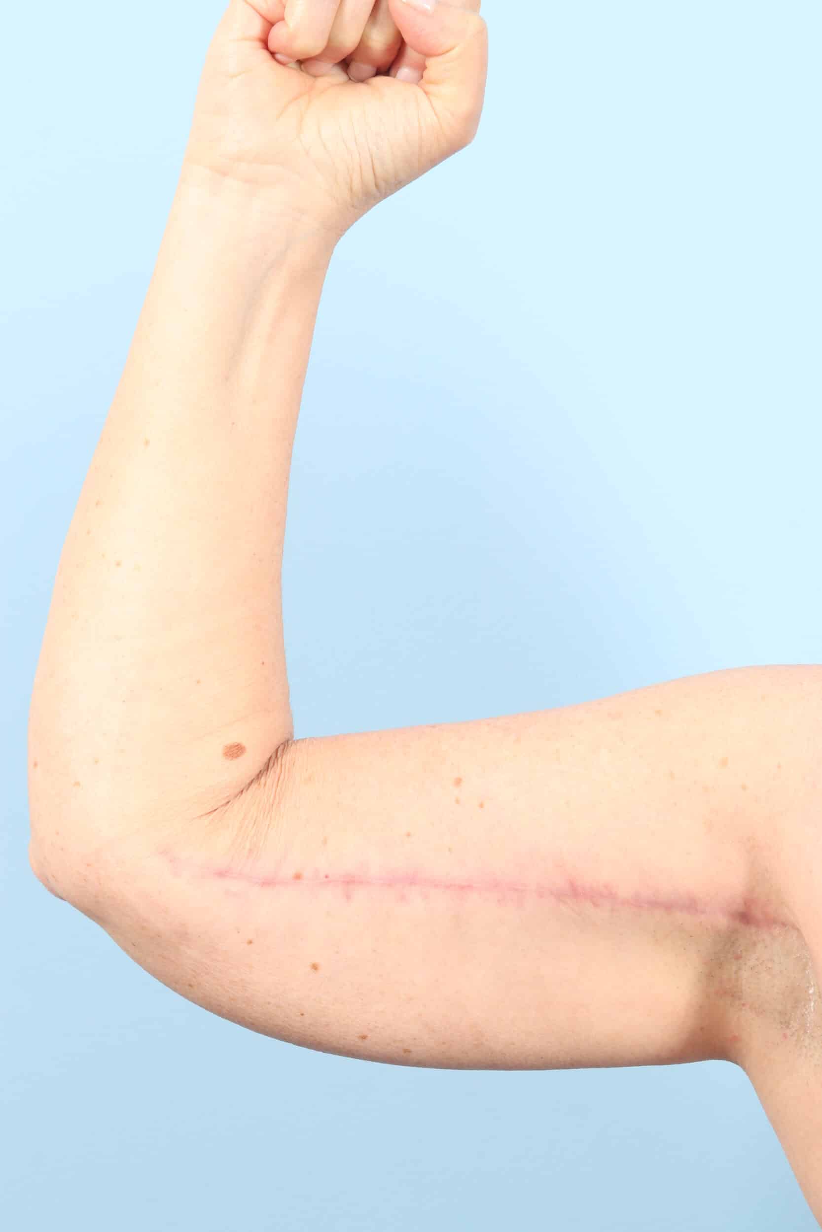 After Image: Arm Kift - front