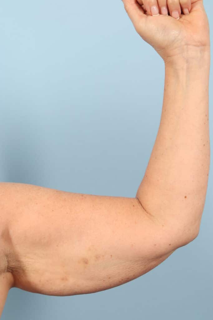 Before Image: Arm Kift - front