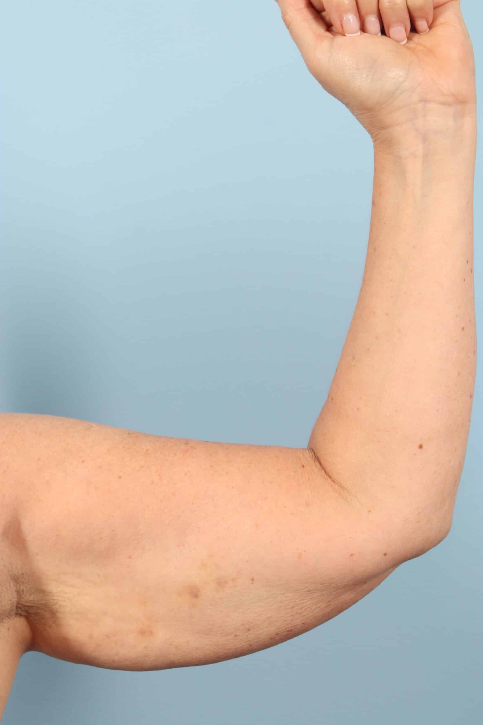 Before Image: Arm Kift - front
