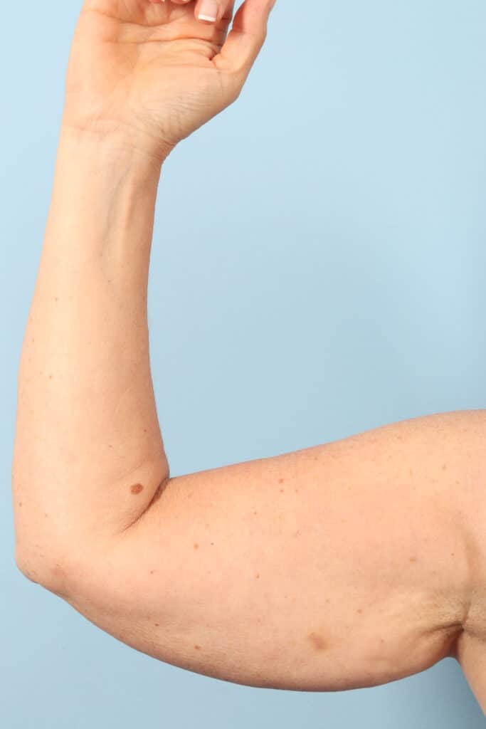 Before Image: Arm Kift - front