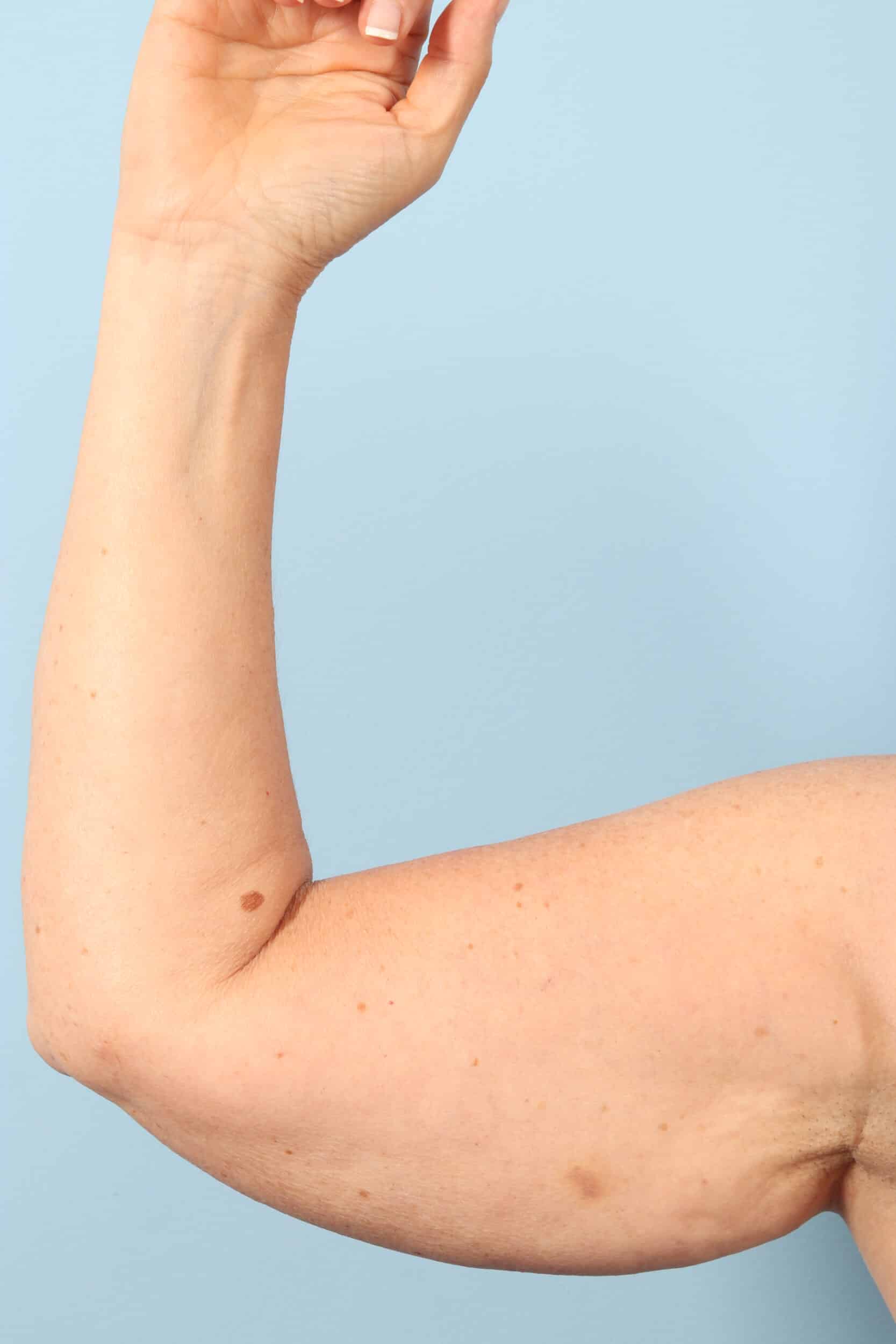 Before Image: Arm Kift - front