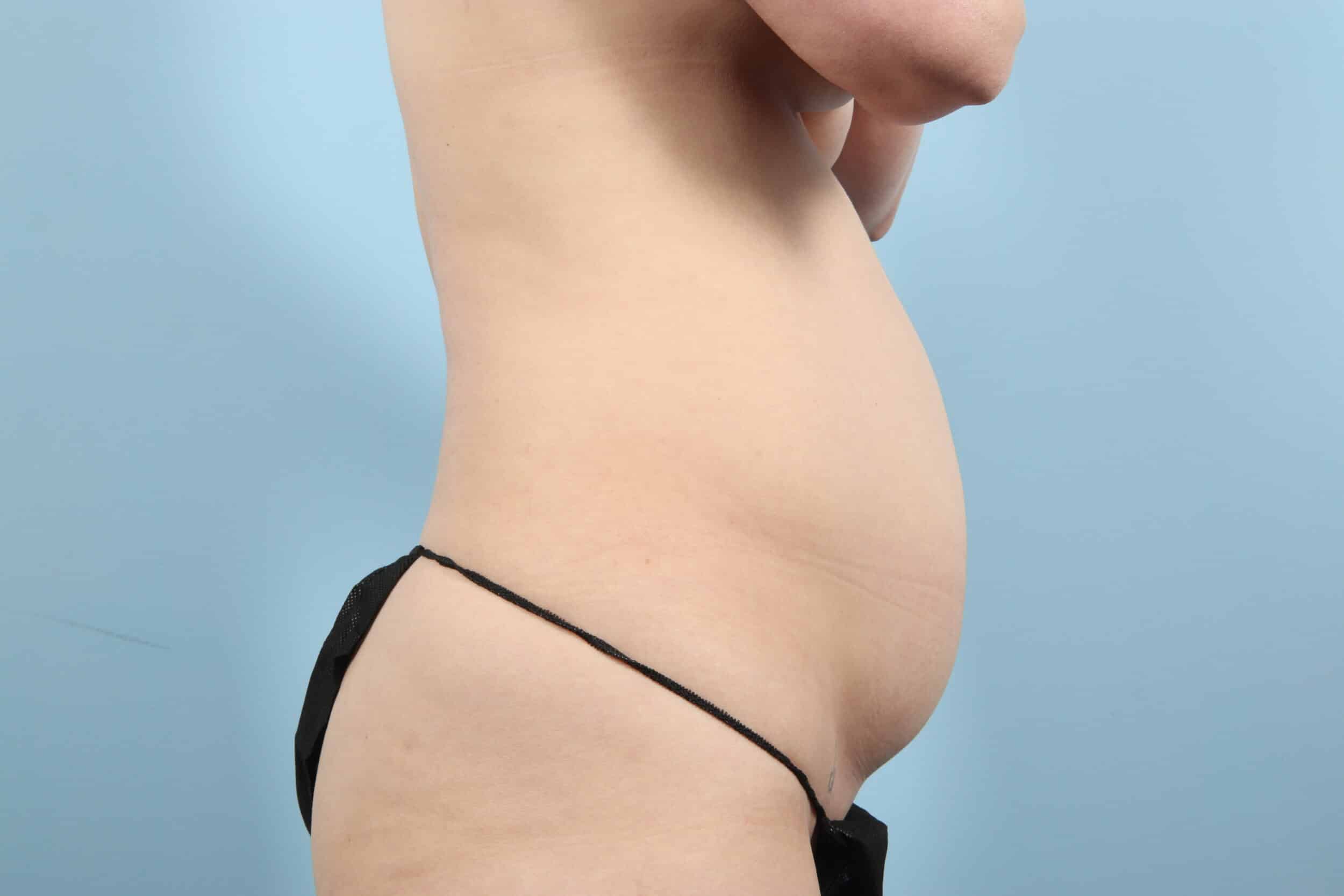 Before Image: Tummy Tuck - right-side