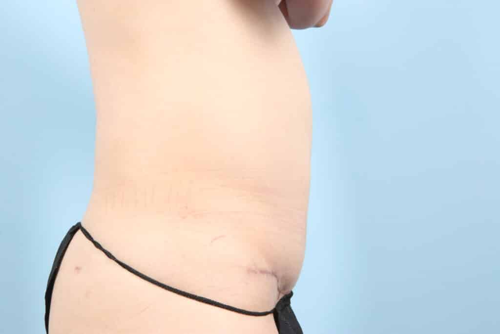 After Image: Tummy Tuck - right-side