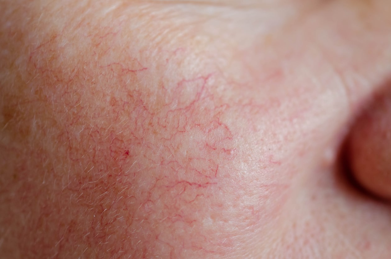 Close-up of visible broken capillaries and small red facial veins on the cheek.