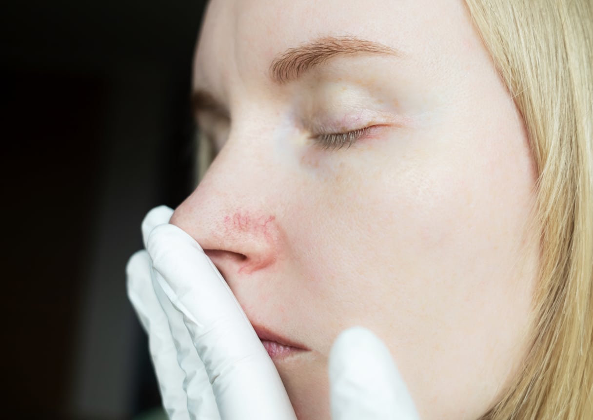 Close-up of visible facial veins around the nose during a cosmetic skin evaluation.